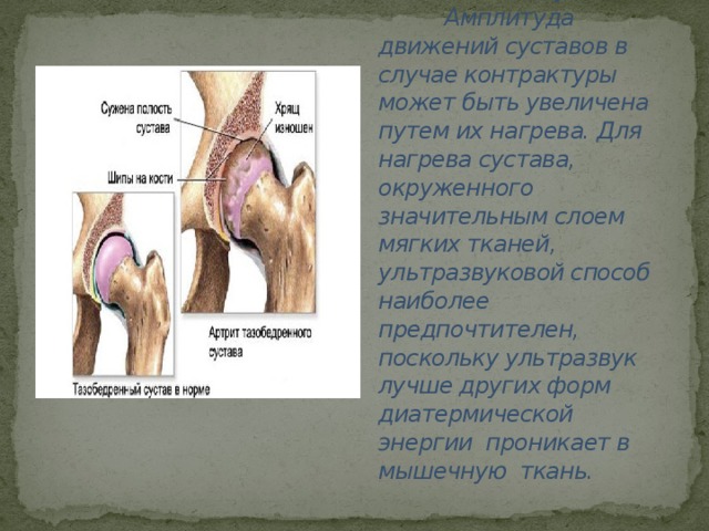 Повышение подвижности суставов.  Амплитуда движений суставов в случае контрактуры может быть увеличена путем их нагрева. Для нагрева сустава, окруженного значительным слоем мягких тканей, ультразвуковой способ наиболее предпочтителен, поскольку ультразвук лучше других форм диатермической энергии проникает в мышечную ткань.